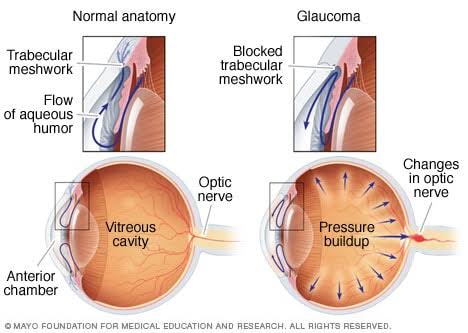 GLAUCOMA (KACHBINDU)
